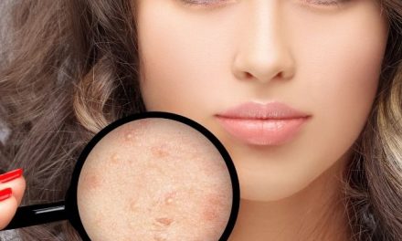 Best Foundation for Acne Scars: Makeup for Scarred Skin and Blemishes in 2021