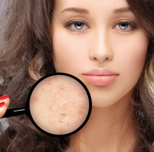 Best Foundation for Acne Scars: Makeup for Scarred Skin and Blemishes in 2021