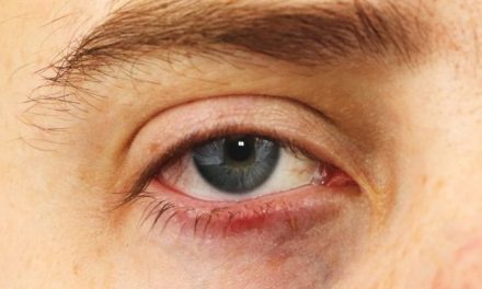 How to Fix Droopy Eyelids Without Surgery: Naturally Tighten Your Eyelids