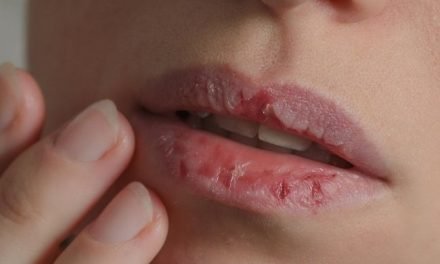 Why are My Lips So Dry Even When I Drink Water?