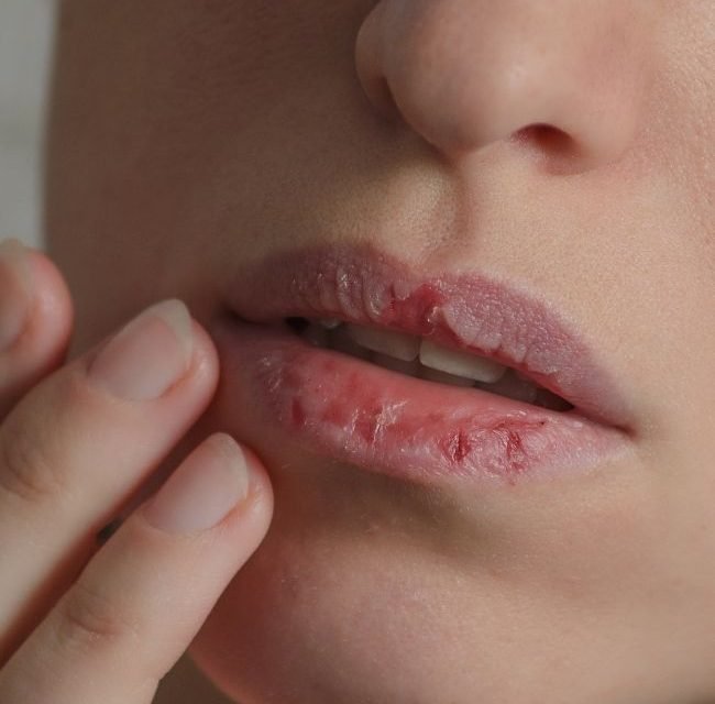 Why are My Lips So Dry Even When I Drink Water?
