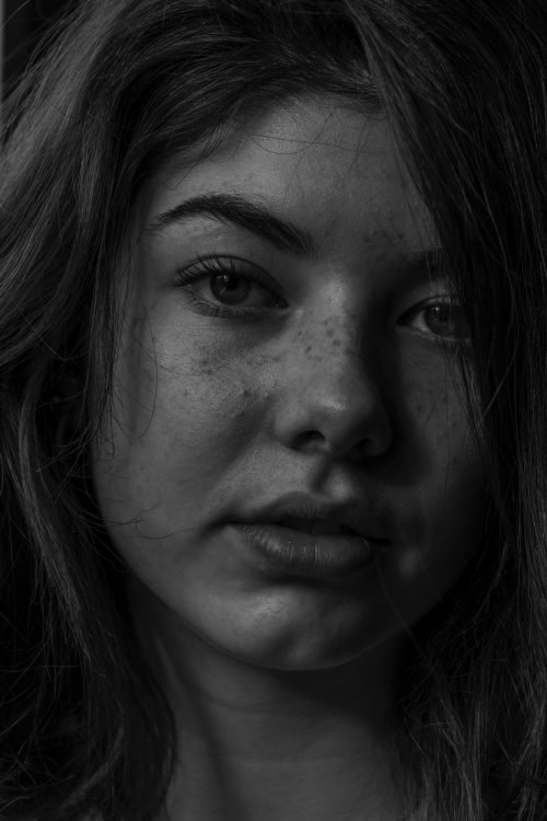 woman's face with acne