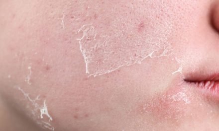 7 Signs Your Skin Barrier Is Damaged (And How to Fix It)