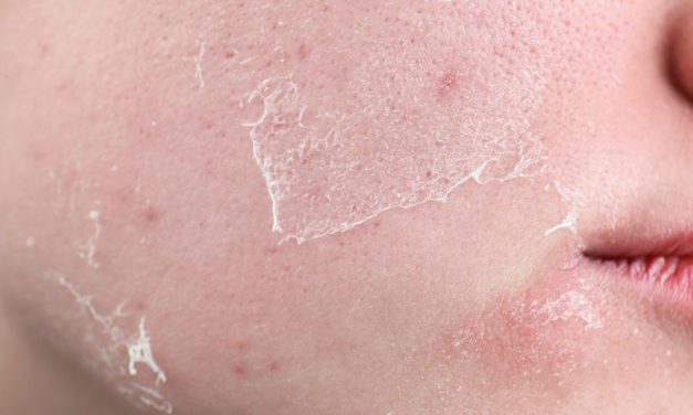 7 Signs Your Skin Barrier Is Damaged (And How to Fix It)