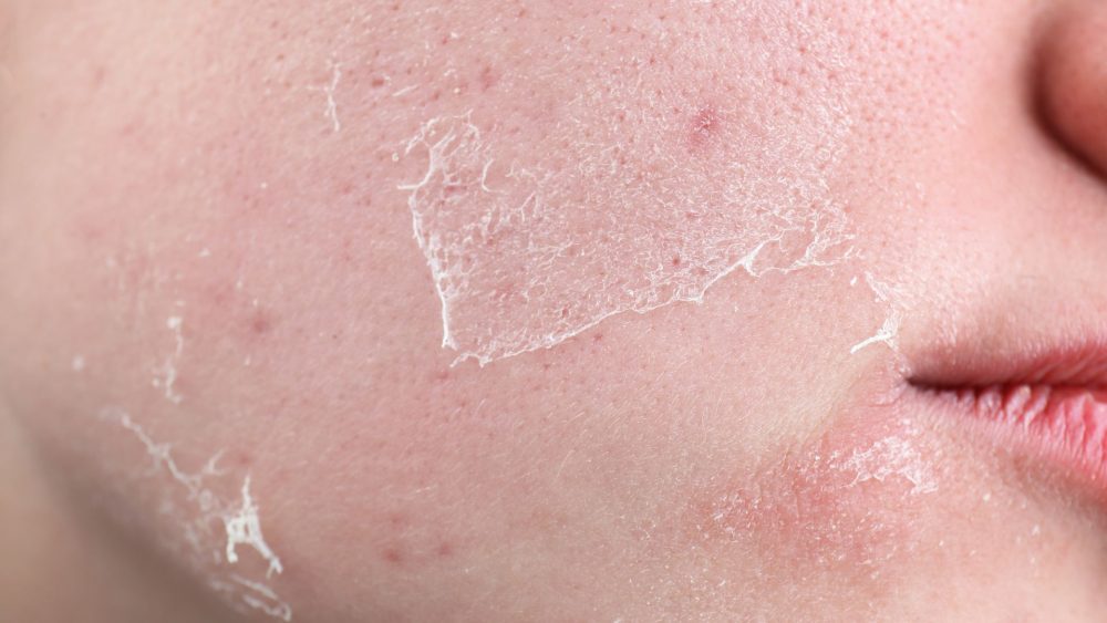 7 Signs Your Skin Barrier Is Damaged (And How to Fix It)