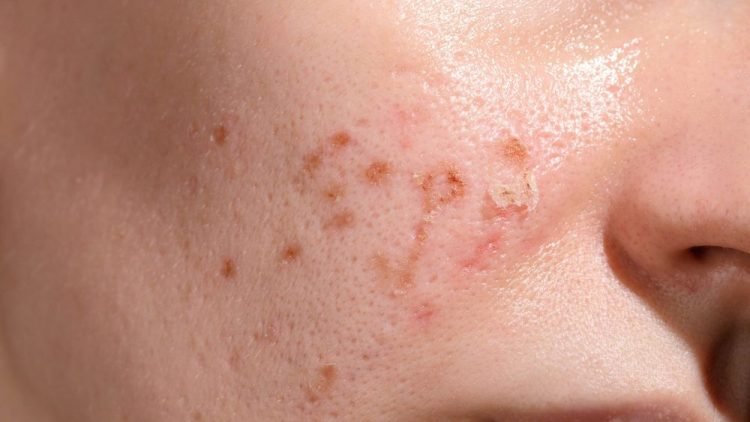 7 Signs Your Skin Barrier Is Damaged (and How To Fix It)